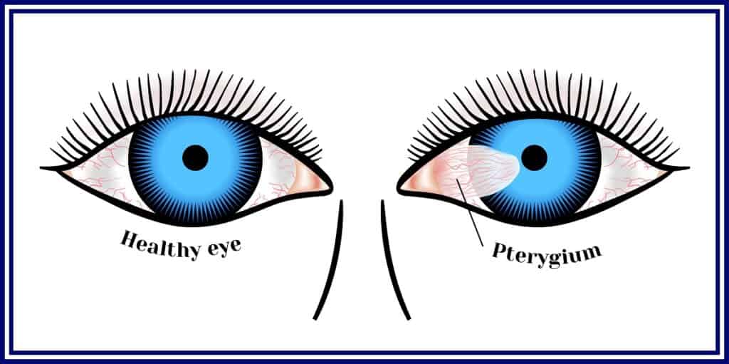 pterygium-archives-mlv