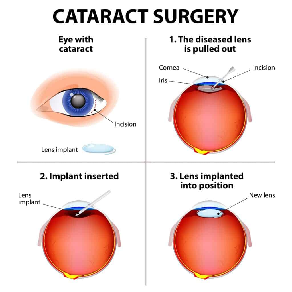 Cataract Surgery Miami Fort Lauderdale Laser Eye Center Of Miami